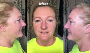 Award Winning Anti Aging Protocol, treatment 8 of 8 - YouTube