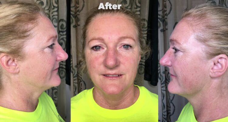 Award Winning Anti Aging Protocol, treatment 8 of 8 - YouTube