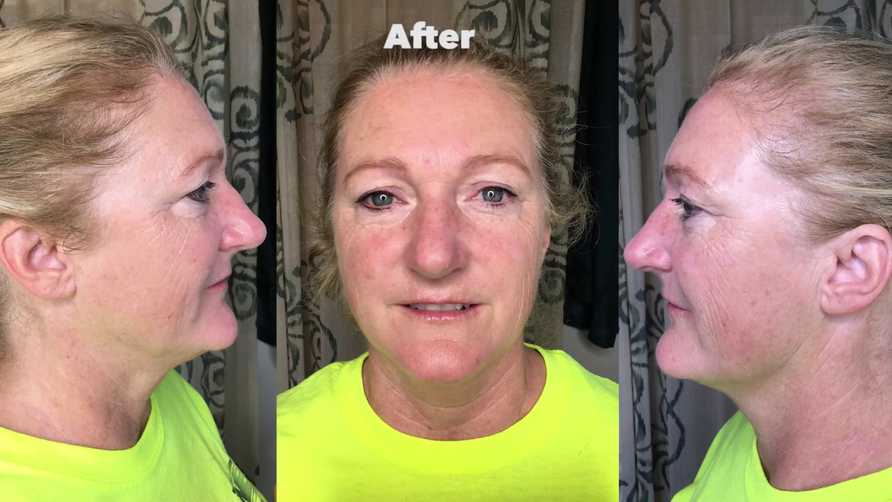 Award Winning Anti Aging Protocol, treatment 8 of 8 - YouTube